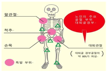 노인의 낙상 골절이 발생하기 쉬운 부위