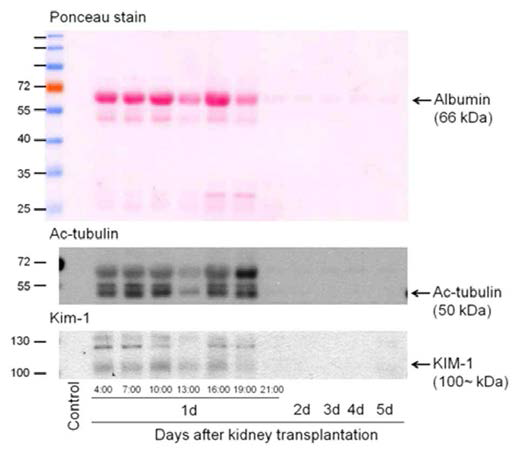 신장이식 환자의 소변 샘플에서의 일차섬모 단백질과 Kim-1의 변화. 신장암 환자의 소변 샘플을 웨스턴 블랏 기법을 이용하여 Ac-tubulin과 Kim-1 단백질 발현을 확인함