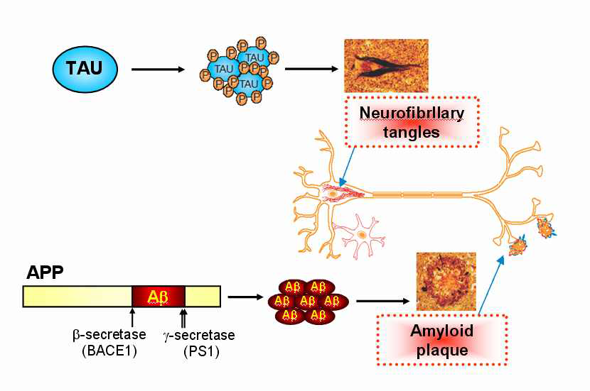 알츠하이머병의 대표적 특징인 신경섬유엉킴 (neurofibrillary tangles) 와 노인반 (amyloid plaques)