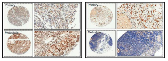 원발암에 비하여 전이암에서 발현이 증가하거나 감소한 대표적인 케이스