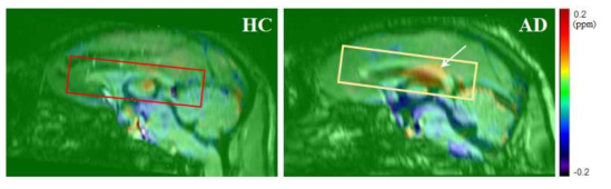 뇌량에서 철 함유량 비교 영상. 네모 박스는 뇌량의 해부학적 위치를 나타내며, 우측 흰색 화살표는 뇌량의 몸통 (callosal trunk/body)을 나타낸다. AD모델에서 이 영역에서 QSM값이 상당히 증가했다