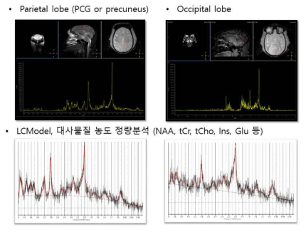 정상 붉은털 원숭이의 뇌에서 얻은 양성자 자기공명분광 스펙트럼. (왼쪽 열, 위) 정상 붉은털 원숭이의 왼쪽 마루엽의 배측 후대상이랑과 설전부 영역에서 얻은 양성자 자기공명분광 스펙트럼. (왼쪽 열, 아래) 왼쪽 마루엽의 배측 후대상이랑과 설전부 영역에서 얻은 양성자 자기공명분광 스펙트럼의 LCModel 분석결과. (오른쪽 열, 위) 정상 붉은털 원숭이의 왼쪽 후두엽 영역에서 얻은 양성자 자기공명분광 스펙트럼. (오른쪽 열, 아래) 왼쪽 후두엽 영역에서 얻은 양성자 자기공명분광 스펙트럼의 LCModel 분석결과. (오른쪽 열, 위) 정상 붉은털 원숭이의 왼쪽 후두엽 영역에서 얻은 양성자 자기공명분광 스펙트럼. (오른쪽 열, 아래) 왼쪽 후두엽 영역에서 얻은 양성자 자기공명분광 스펙트럼의 LCModel 분석결과