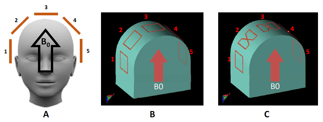 A. Wearable head coil 구성, B0 field 방향과 coil element들의 동작특성을 관찰하기위한 RF EM field simulation을 구성하였으며 B. 5개의 loop형태 coil로 구성된 경우, C. 2개의 loop（1, 5번 채널)과 3개의 butterfly (2, 3, 4번 채널) coil로 구성된 경우