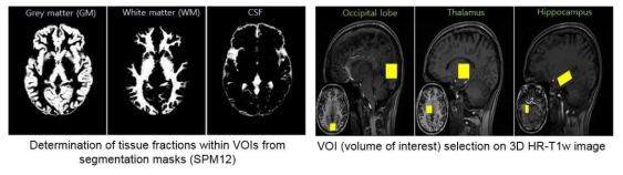 s-MRI 영상에서 만든 회백질, 백질 및 뇌 척수액 확률분포맵 (좌)와 sMRI 영상에서 선택한 영역별 마스크 (우)