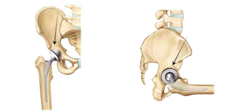 환자의 3D CT 자료 분석을 통해 대퇴골과 골반뼈 주변의 각도 및 강화방안의 분석이 가능함