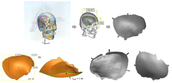 비압축 DICOM 데이터 기반 뇌함몰 충진용 두개골 3D 모델 및 결손부 역설계