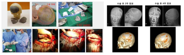 뇌 함몰부 충진 가능 두개골 성형재료 임상시험 사진