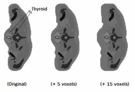 Modification of overlying tissue thickness applied to the ICRP adult male reference computational phantom: (a) original phantom, (b) +5 voxels in the forepart of the phantom, (c) +15 voxels in the forepart of the phantom