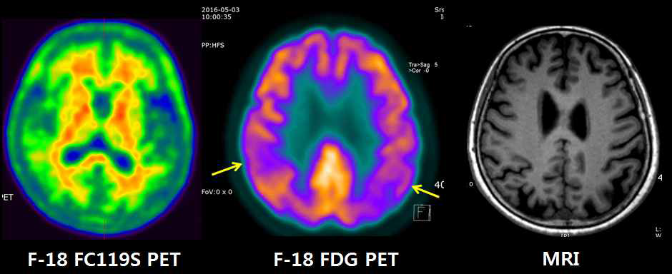 경도인지장애 환자의 18F-FC119S PET, 18F-FDG PET 및 MRI