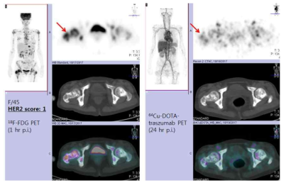 조직검사 상 낮은 HER2 발현정도(grade1)를 보이는 유방암 뼈전이 환자에서 촬영한 18F-FDG PET(왼쪽)과 64Cu-DOTA-trastuzumab PET영상 (오른쪽). 화살표는 뼈전이 부위임
