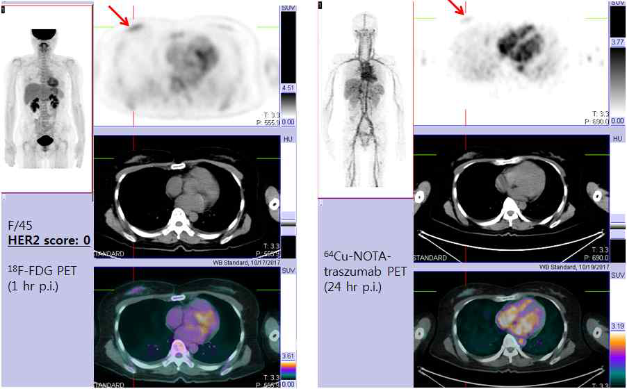 조직검사 상 HER2 미발현(grade0)를 보이는 유방암 환자에서 촬영한 18F-FDG PET(왼쪽)과 64Cu-DOTA-trastuzumab PET영상 (오른쪽). 화살표는 우측 유방암 부위임