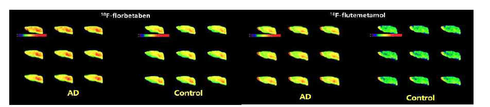 대조군 (WT)과 실험군 (AD) 뇌에서의 PET 영상 비교