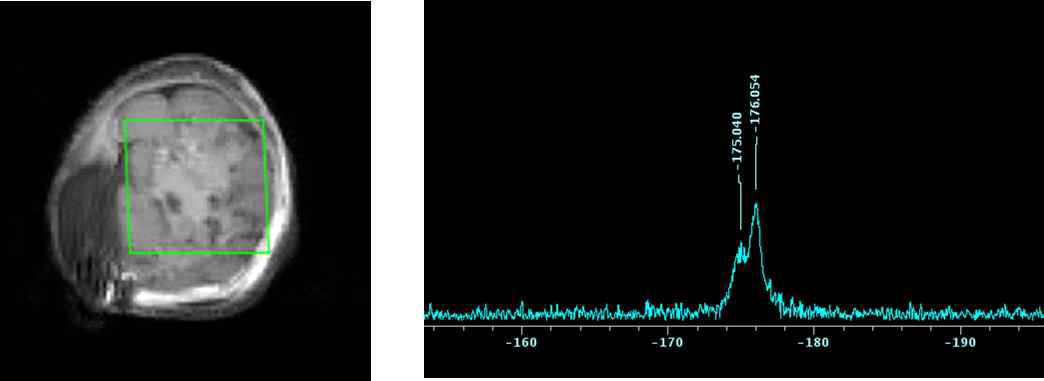 간종양 위치 선정 (좌) 19F-MRS (우)