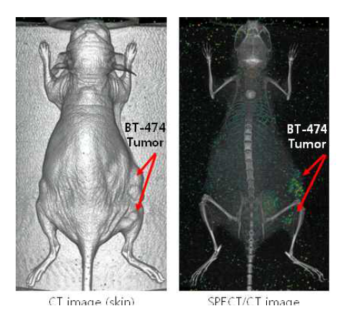 I-125 SPECT/CT 3D 영상