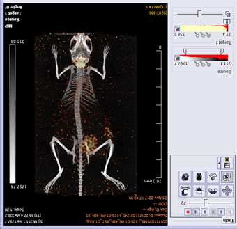 I-125 SPECT/CT MIP 영상