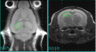 T1WI MRI (좌), hippocampus 에 voxel (1.2*1.5*2.0 mm)을 위치시키고 MRS 스펙트럼 획득 (우)