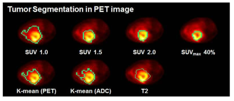 Segmentation 알고리즘에 따라 정의된 종양영역