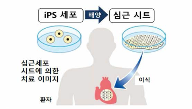 유도만능줄기 심근세포 이식 개념도(뉴스웍스 수정인용)