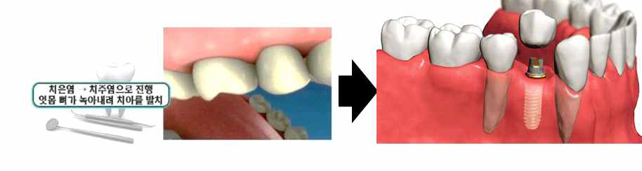 잇몸질환 및 치아상실에 의한 임플란트 식립