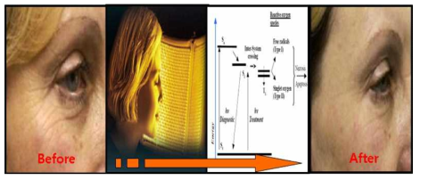 광‧역학 치료법에 의한 피부노화 및 미백 기술