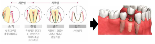 치주질환의 진행단계 및 치아 상실 후 임플란트 식립