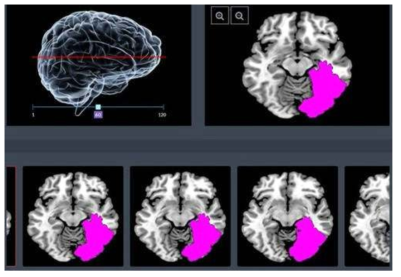 인공지능 기반 뇌경색 MR영상 진단 소프트웨어