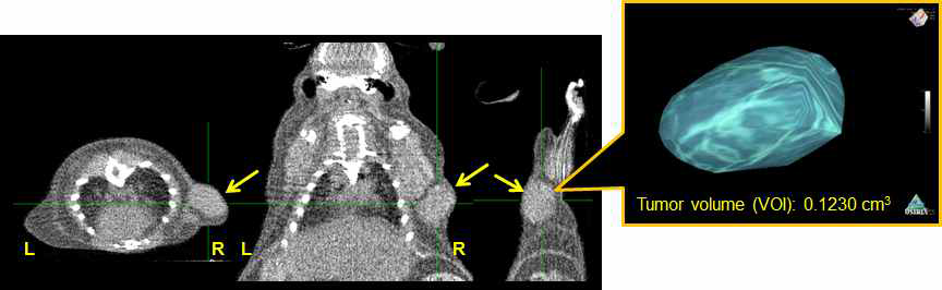 Osirix software를 이용한 tumor의 VOI 측정