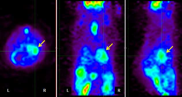 Lung cancer mouse에서 항암제 투여 후 Lung cancer의 변화를 영상을 이용하여 follow-up