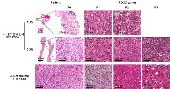 환자의 종양 조직(F0)과 PDX 모델의 종양조직(F1, F2, F3)의 H&E 염색