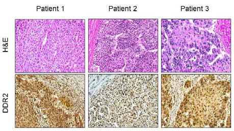 Immunohistochemical staining of DDR2 in HCC patient tumor tissues