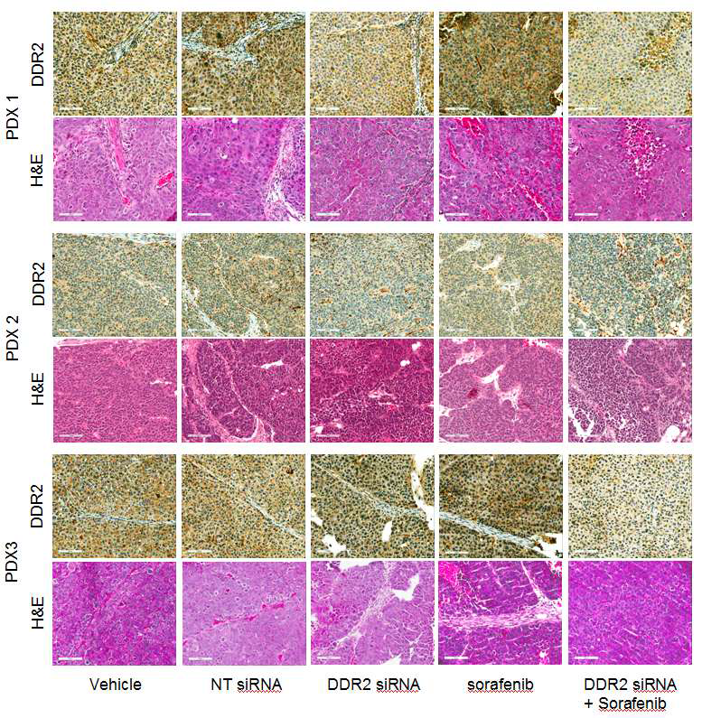 Detection of DDR2 protein expression by immunohistochemical assay of tumor tissues in PDX models in different treated groups (200x). NT siRNA, non-target siRNA