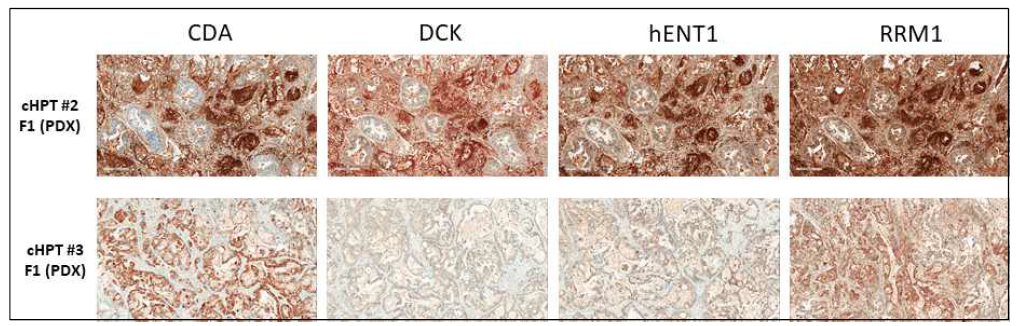 담도계암 환자유래이종이식 모델의 종양의 면역화학염색 확인