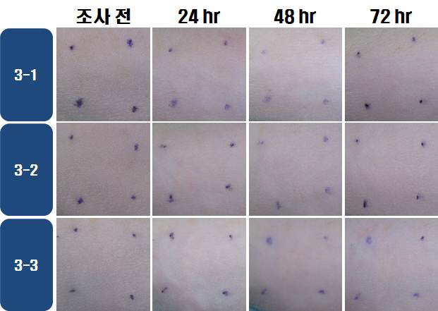 IBF 25 w/v %의 광조사량 선정시험 결과 ( 20 J/cm2 )