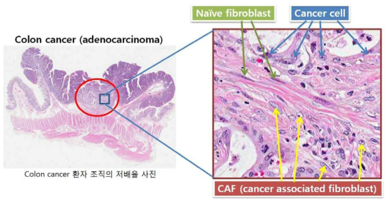 실제 대장암 환자 조직에서 관찰한 악성상피세포(암세포) 주변의 암 미세환경