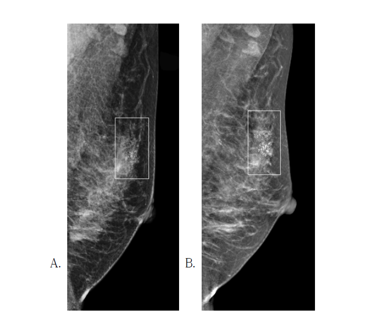 Ductal carcinoma in situ로 진단된 52세 여성 A and B. Fine pleomorphic calcification (squares) in the left upper breast is equally seen on FFDM (A) and synthetic mammography (B)