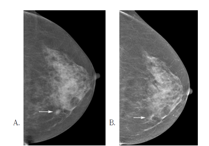 Superimposed tissue that mimics an asymmetry on FFDM A. FFDM CC view shows an asymmetry (arrow) in the inner portion of the left breast that needs to be recalled without DBT images. B. Synthetic mammography (B) reveals fibroglandular tissues (arrows) without associated mass. The patient can return to annual screening