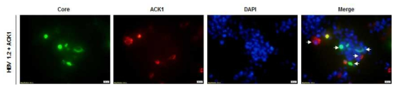 IFC 분석을 통한 ACK1과 HBV core 단백질 발현. 화살표; ACK1 혹은 HBV core만 발현하는 세포