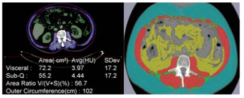 Body composition analysis using single Lumbar 3 level slice CT image (Green: subcutaneous fat, Yellow: visceral fat, Red: skeletal muscle)