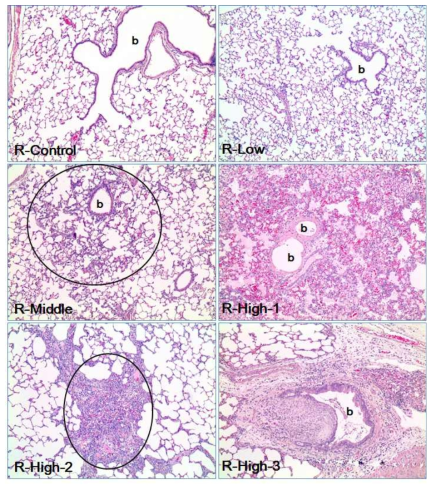 Histological features of representative lung of each ITI recovery group. In the lungs of normal and low dose group, no specific abnormal findings were noted. Multifocal chronic inflammation was noted in the middle and high dose groups. Note the alveolar fibrosis with mild inflammatory cell infiltration (circle). In the high dose group, pulmonary edema (R-High-1) was evident, and multifocal chronic inflammation with alveolar fibrosis (R-High-2) were observed in all animals. In R-High-1, also note the necrotic bronchiolar epithelia (b). In R-High-3, note the polypoid inner growth of bronchiolar lamina propria (b) with epithelial hypertrophy and hyperplasia. H&E. Mag.=X100