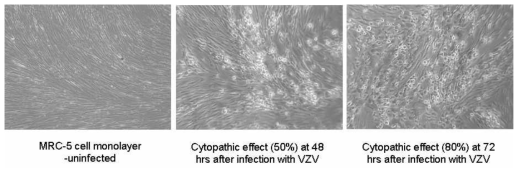 MRC-5 세포에 감염된 varicella zoster virus (VZV)의 cytopathic effect (cytopathic effect: foci of enlarged cells with nuclear inclusions; rounding in advanced infection)