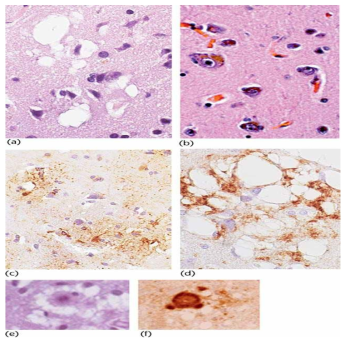 Pathology of prion disease. (a) H&E staining of CJD brain showing spongiform degeneration (b) H&E staining of normal brain (c) Immunohistochemistry of GFAP showing astrogliosis of CJD patients (d) Misfolded prion proteins deposition of CJD brain (e, f) H&E staining and immunohistochemistry showing florid plaques in CJD brains