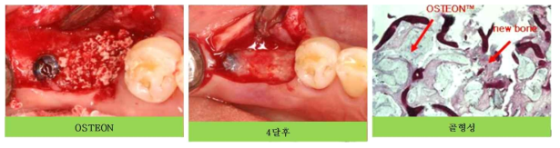 OSTEON으로 시술한 임상 결과