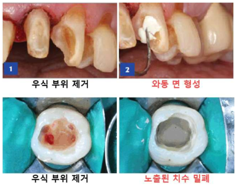 와동이장재의 적용 부위