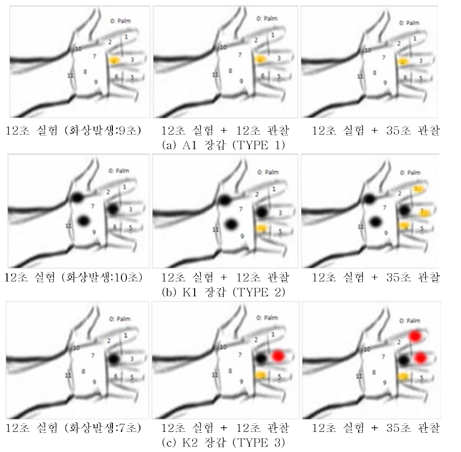 손 부위 화상발생 실험 결과