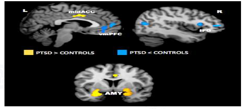 fMRI(Functional Magnetic Resonance Imaging) 영상