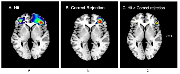 Bilateral ventrolateral prefrontal cortex (VLPFC) showing significant activation differences between the hit and correct rejection conditions. Significantly activated voxels in the hit condition (A) and correct rejection condition (B). (C) Compared to the correct rejection condition, voxels in bilateral VLPFC showed higher activation in the hit condition (uncorrected P<.005)