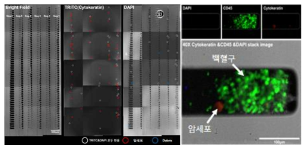 순환종양세포 검침용 바이오칩 내 포집된 유방암 환자의 암세포