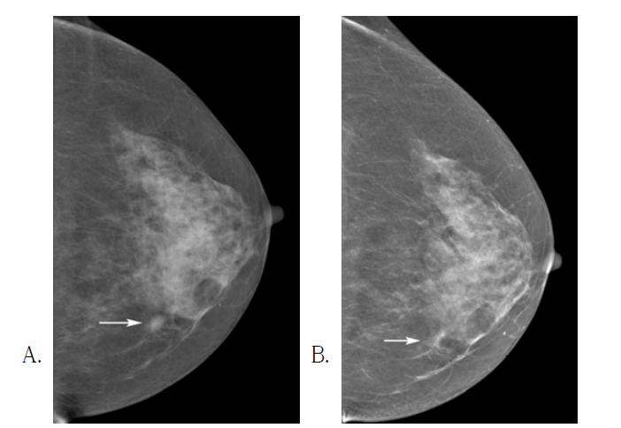 Superimposed tissue that mimics an asymmetry on FFDM