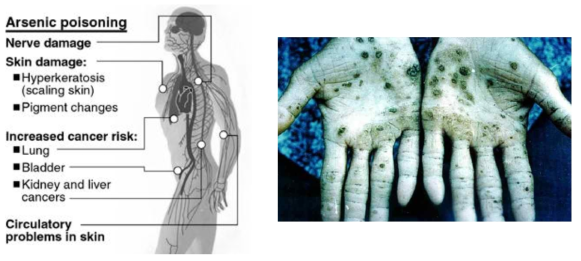비소 중독이 인체에 미치는 영향 및 피부질환 (source: Prezi & Ualberta)