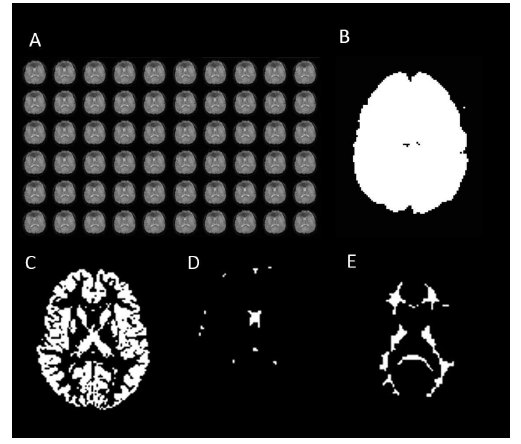 Resting state function MRI에서 3D-T1 image data 정합을 이용하여 만든 brain mask 와 tissue mask들: A. resting state fMRI B. brain mask of resting state fMRI. C. mask of gray matter. D. mask of CSF. E. mask of white matter